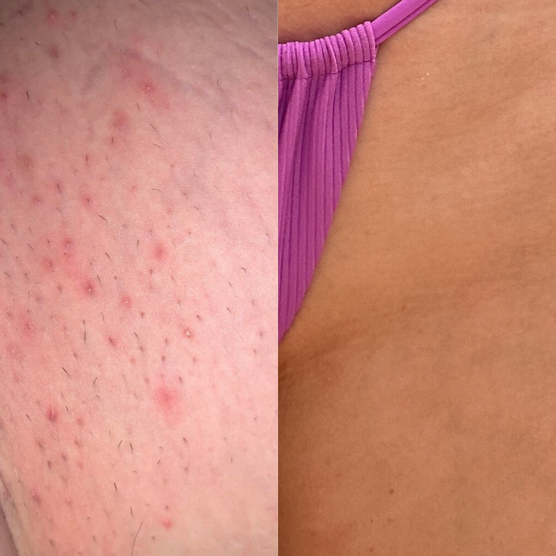 How to Get Rid of Redness Fast in the Bikini Line Area