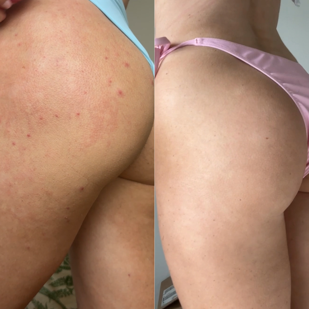 Why Do I Get Pimples on My Butt? (And How to Actually Treat Them)