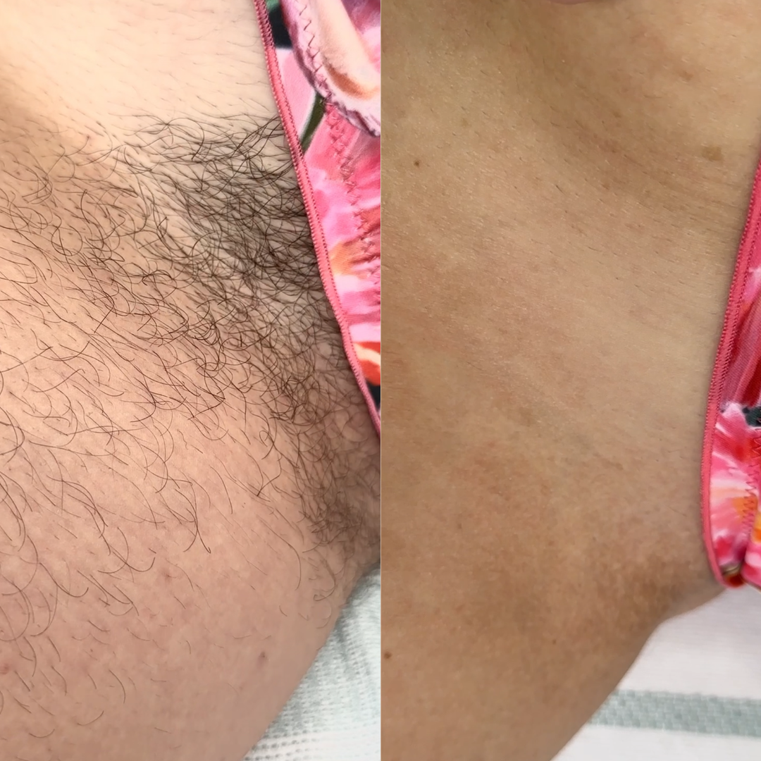 If You Have a Massive Bush and Need to Shave It for Summer—Read This First